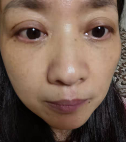 去眼袋手术