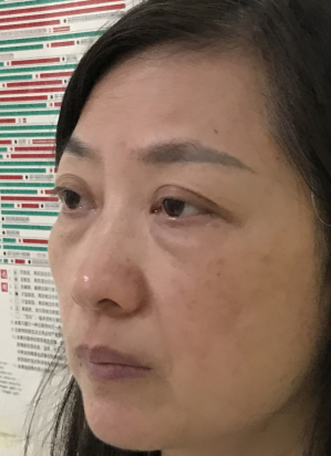 去眼袋手术