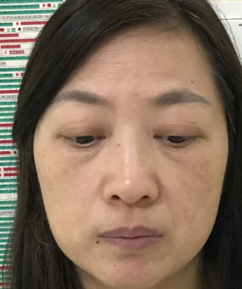 去眼袋手术