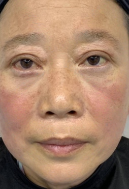 去眼袋手术