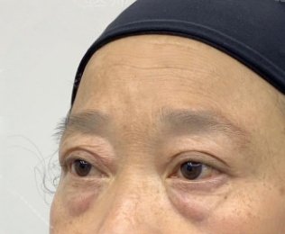 去眼袋手术