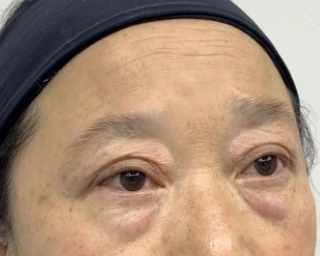 去眼袋手术