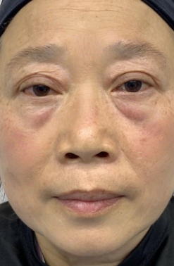 去眼袋手术
