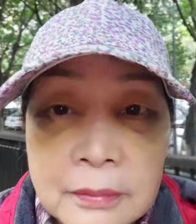去眼袋手术