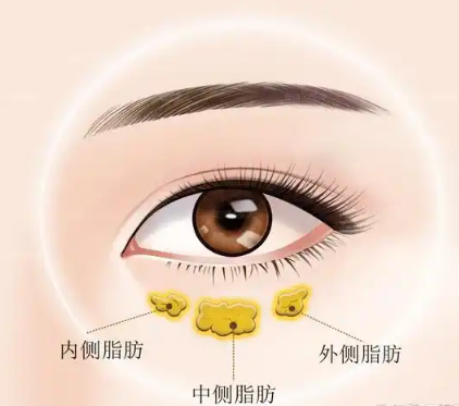 去眼袋手术
