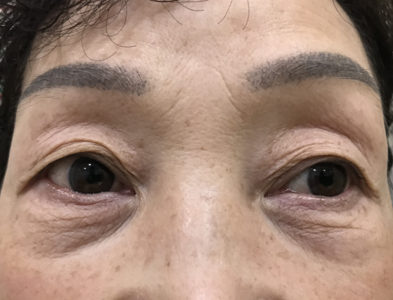 去眼袋手术