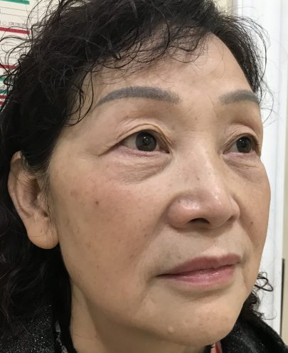 去眼袋手术