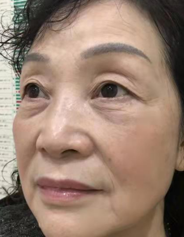 去眼袋手术