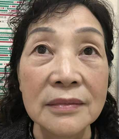 去眼袋手术