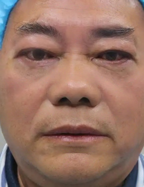 去眼袋手术