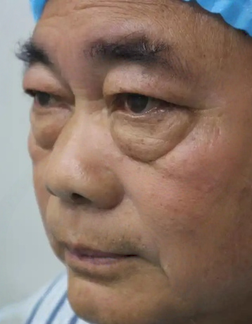 去眼袋手术