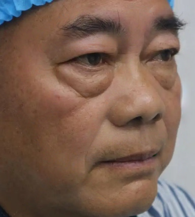 去眼袋手术