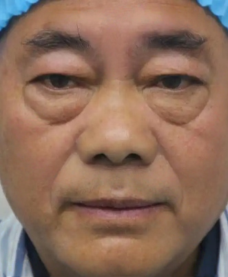 去眼袋手术