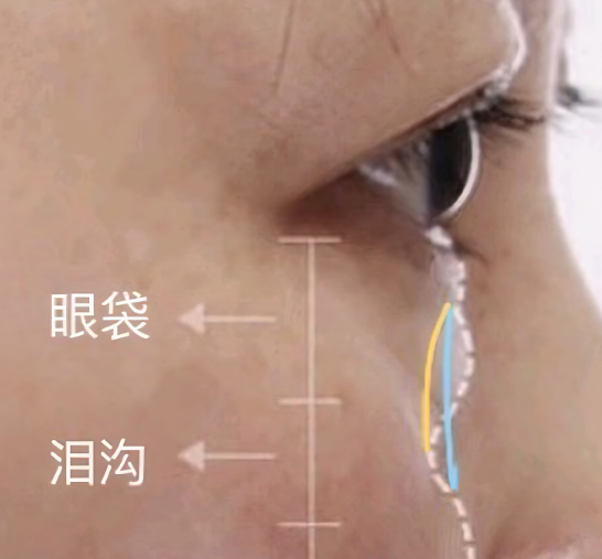 去眼袋手术