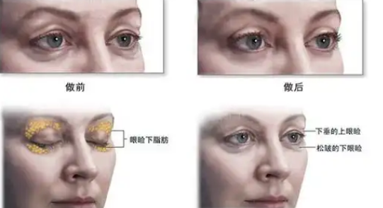 去眼袋手术