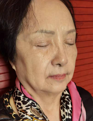 去眼袋手术
