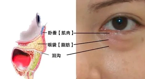 去眼袋手术