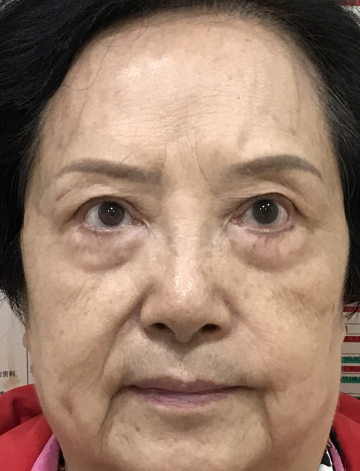 去眼袋手术