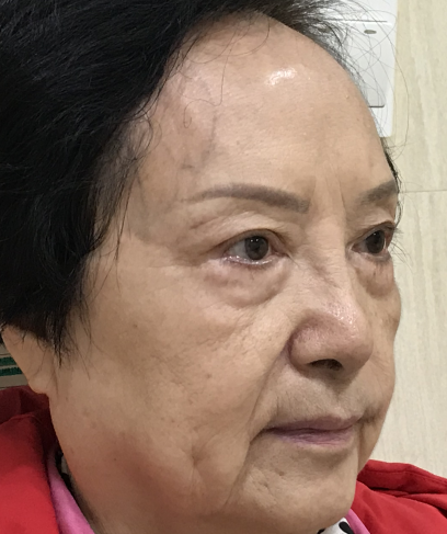 去眼袋手术