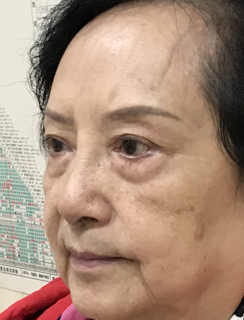 去眼袋手术