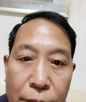 去眼袋手术