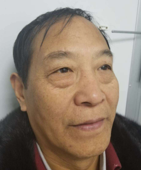 去眼袋手术