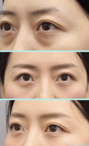去眼袋手术