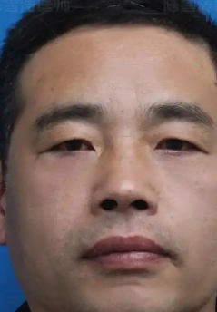 去眼袋手术
