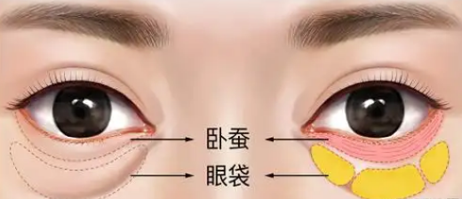 去眼袋手术