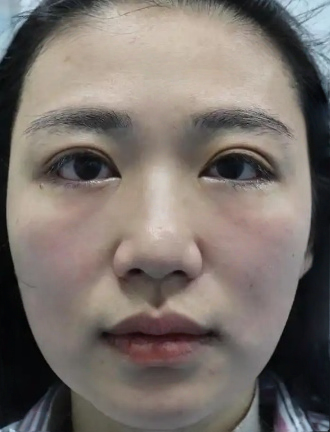 去眼袋手术