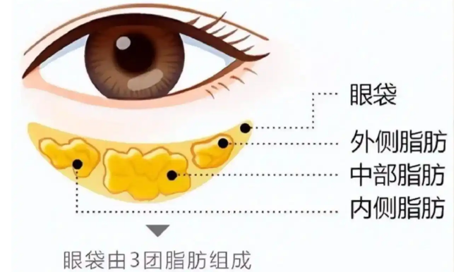 去眼袋手术