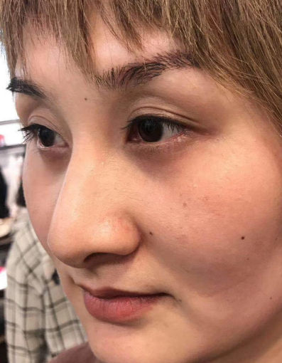 去眼袋手术
