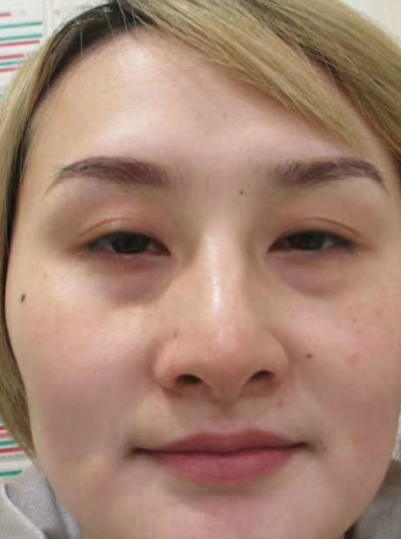 去眼袋手术