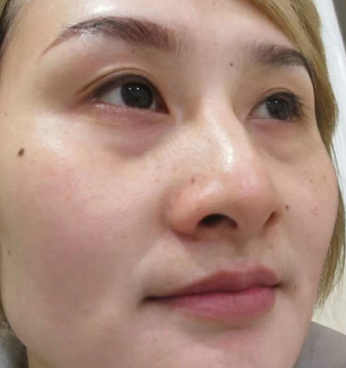去眼袋手术