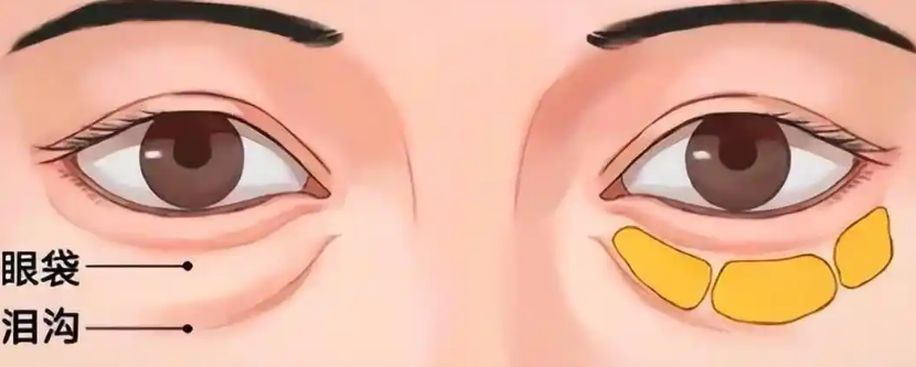 去眼袋手术