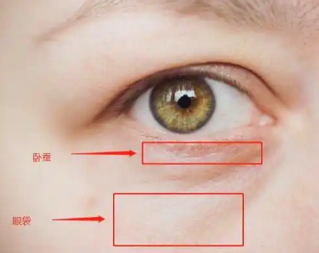 去眼袋手术