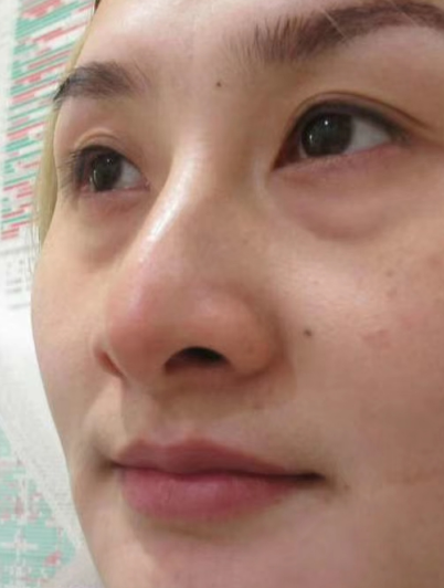 去眼袋手术