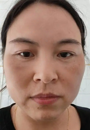 去眼袋手术