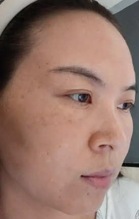去眼袋手术