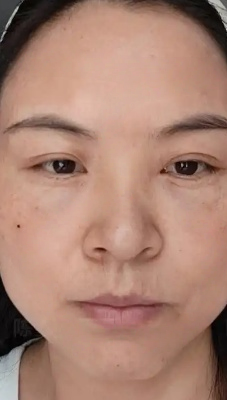 去眼袋手术