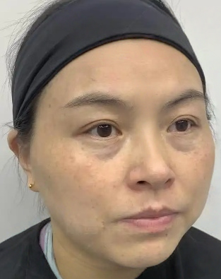 去眼袋手术
