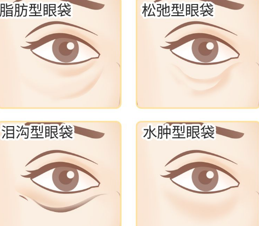 去眼袋手术