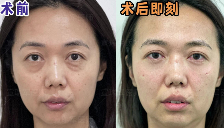 去眼袋手术