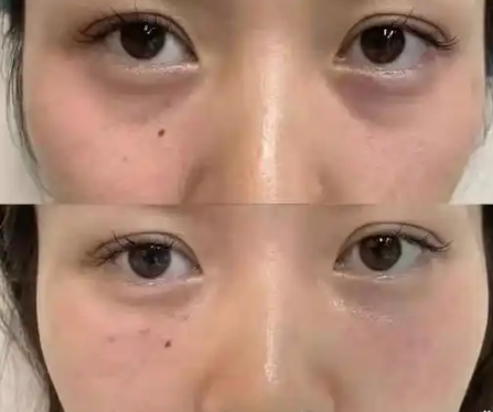 去眼袋手术