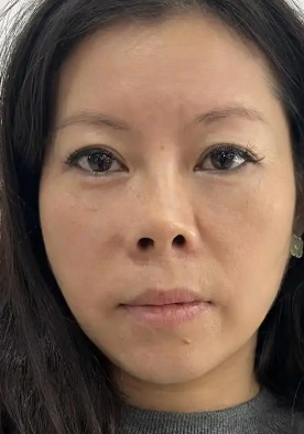 去眼袋手术