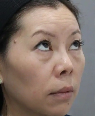 去眼袋手术