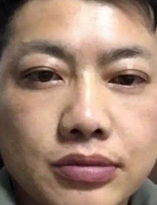 去眼袋手术