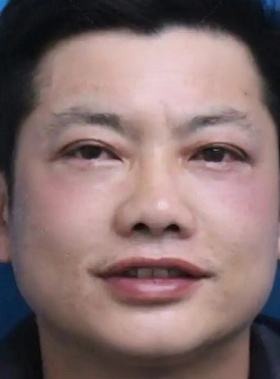 去眼袋手术