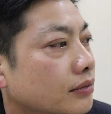 去眼袋手术