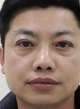 去眼袋手术